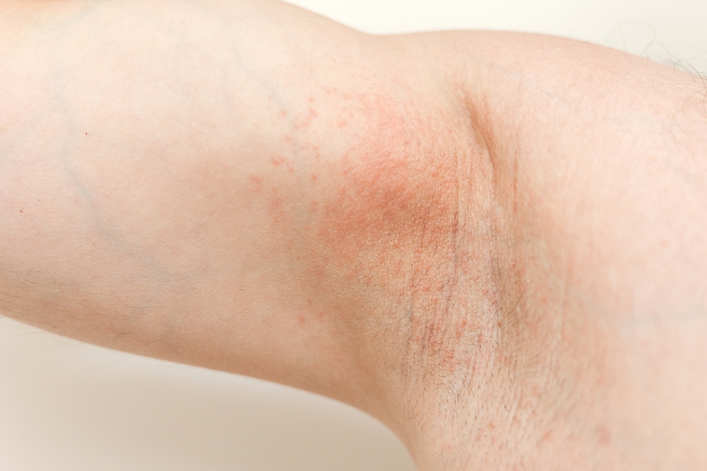 Zbliżenie na podrażnioną skóre pod pachami